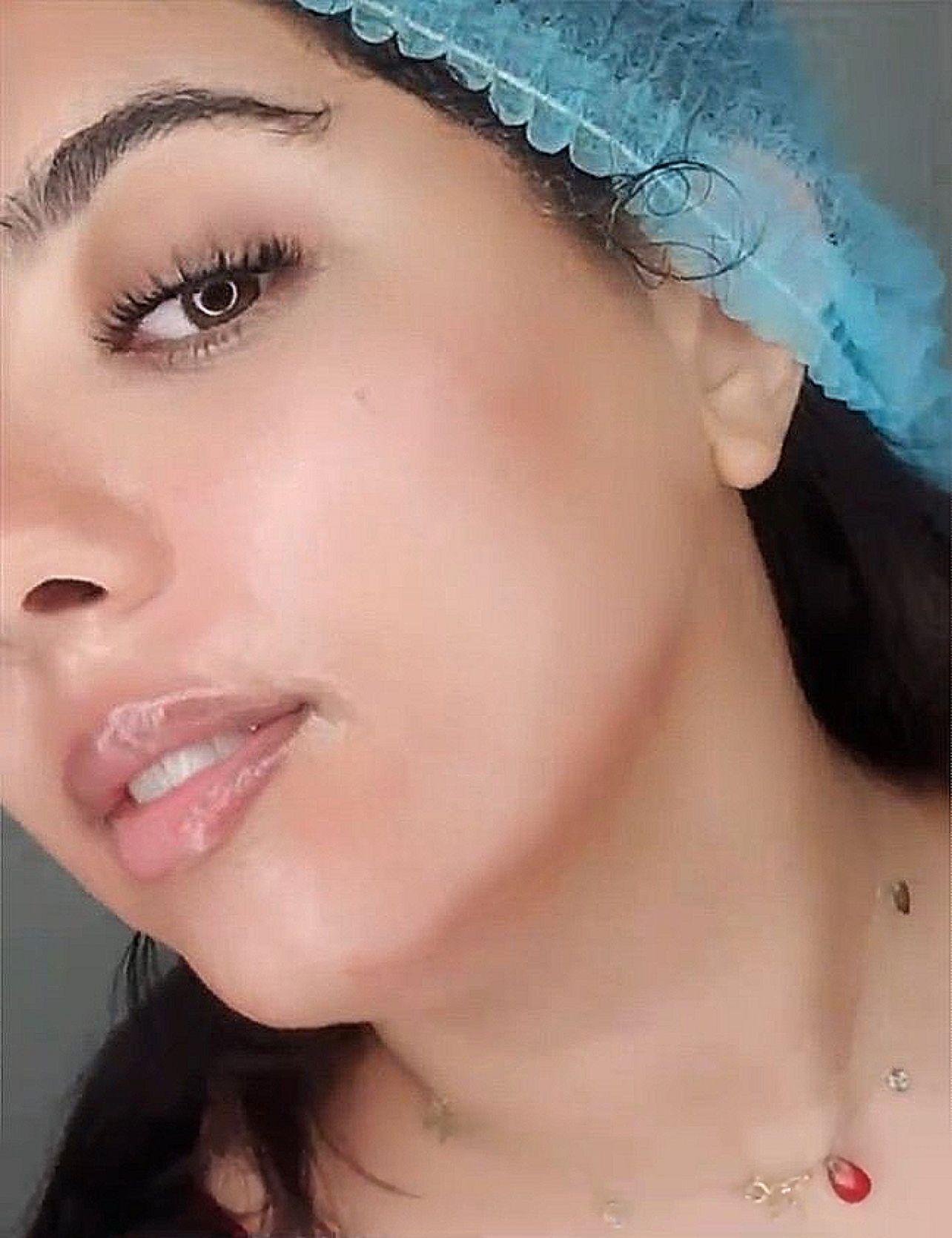 Micro-Needling in Marrakech